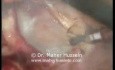 Resección anterior baja del colon - abordaje laparoscópico