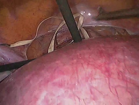 Cerclaje cervical con laparoscopia