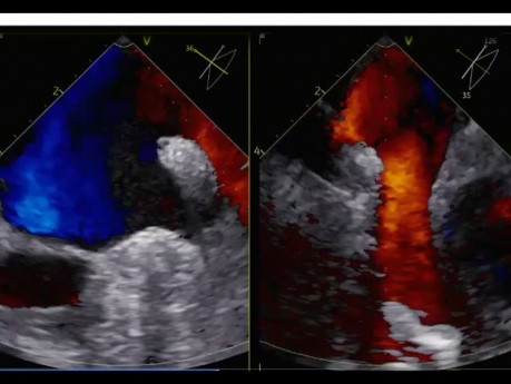 8. Caso de ecocardiografía - ¿Qué se ve?