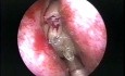 Sobre el origen de la aplicación de la afeitadora artroscópica en la cirugía endoscópica de los senos nasales (vídeo histórico)