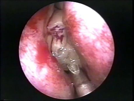 Sobre el origen de la aplicación de la afeitadora artroscópica en la cirugía endoscópica de los senos nasales (vídeo histórico)