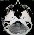 Hemorragia Subdural Aguda Espontánea en el Espacio Subdural