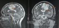 Planificación quirúrgica con neuronavegador en paciente con lesión de masa intracraneal. Glioma de alto grado.