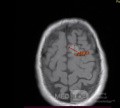 Estirpación de cavernoma subcortical 