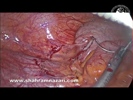 Apendicectomía laparoscópica con grapadora