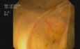 Enterobiasis