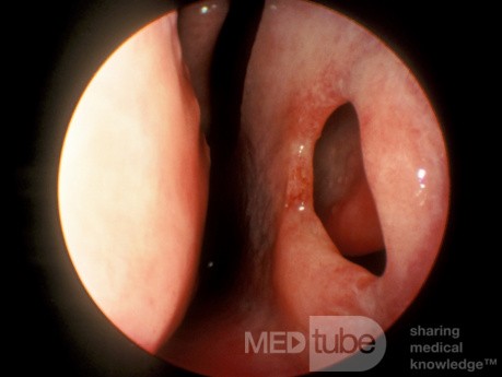 Perforación del tabique nasal