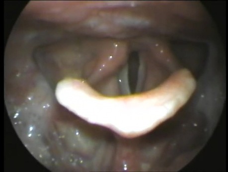 Parálisis de las cuerdas vocales