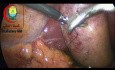 Sutura para tracción de la vesícula biliar en casos agudos
