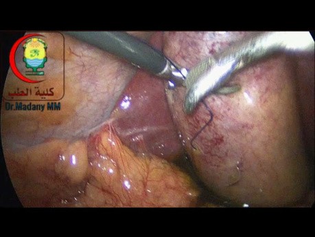 Sutura para tracción de la vesícula biliar en casos agudos