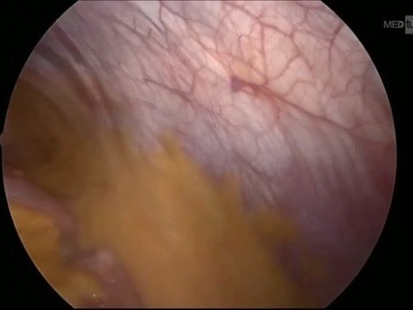 Adhesiólisis robótica para obstrucciones recurrentes del intestino delgado