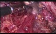 Cirugía citorreductora del cáncer de ovario. Peritonectomía pélvica laparoscópica.