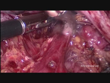 Cirugía citorreductora del cáncer de ovario. Peritonectomía pélvica laparoscópica.