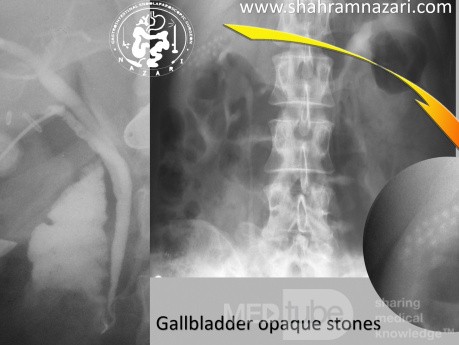 Cálculos opacos de la vesícula biliar