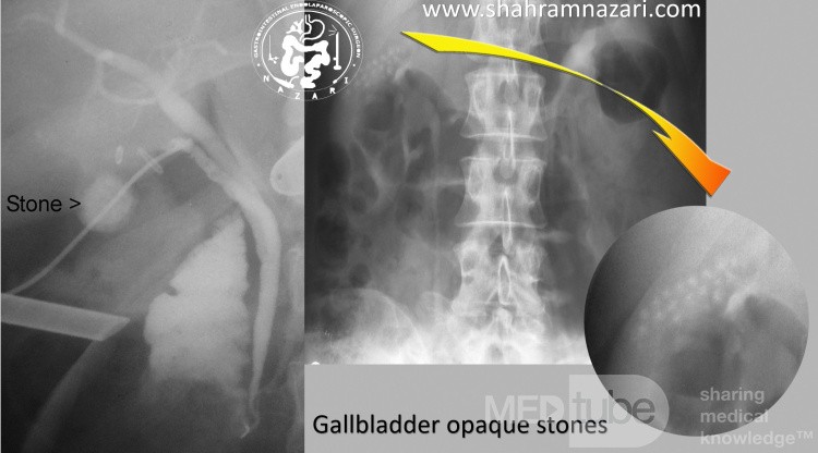 Cálculos opacos de la vesícula biliar