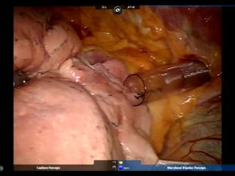 Neumonectomía robótica subxifoidea derecha