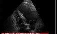Infarto de miocardio de la pared anterior antiguo - Anomalía del movimiento de la pared apical del ventrículo izquierdo (eco)