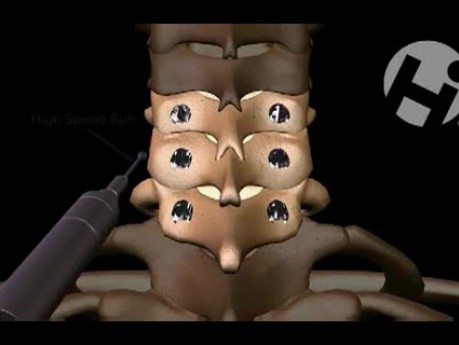 Implantación posterior C5-C7