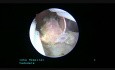 Pólipo endometrial de la pared posterior del útero