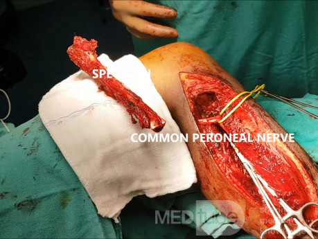 Sarcoma de Ewing de cabeza de peroné