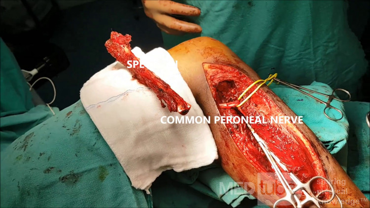 Sarcoma de Ewing de cabeza de peroné