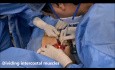 Escisión del condrosarcoma de la pared torácica bajo guía toracoscópica (VATS)