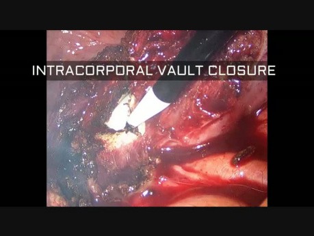 Histerectomía laparoscópica total para útero fibroide