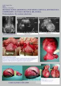 Mioma Cervical Sintomatico Histerectomia Abdominal
