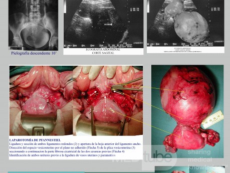 Mioma Cervical Sintomatico Histerectomia Abdominal