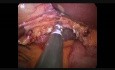 Colecistectomía Laparoscópica de Incisión única (SILS) con Gelpoint y Gancho Articulado