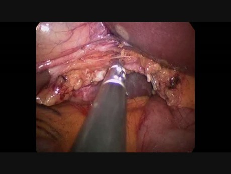 Colecistectomía Laparoscópica de Incisión única (SILS) con Gelpoint y Gancho Articulado