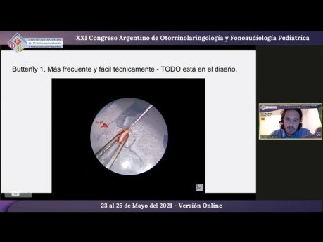 Webinar Timpanoplastias Tipo 1 Endoscópicas en Pediatría - Congreso AAOFP 2021