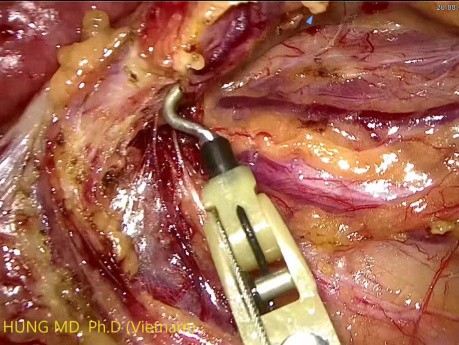 Resección anterior alta laparoscópica de tumor de colon sigmoide enorme