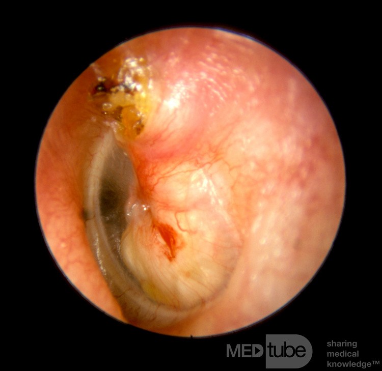 Colesteatoma grande en el oído medio