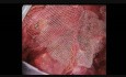 Reparación laparoscópica de hernia inguinal - paso a paso