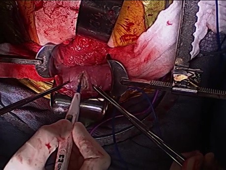 Movilización laparoscópica del colon derecho asistida por mano para cecocistoplastia ileal cutánea continente
