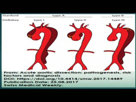 Disección Aórtica: Ecocardiografía transesofágica, angiografía de tórax y tratamiento