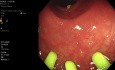 Colonoscopia de screening