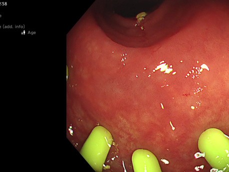 Colonoscopia de screening