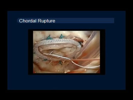 10 casos de técnicas quirúrgicas de reparación de la válvula mitral