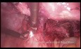 Laparoscopia para la endometriosis rectovaginal grave