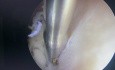 Pólipo endometrial 