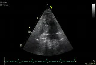 Compresión auricular izquierda