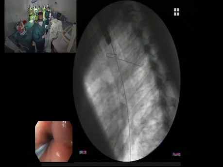 Procedimiento de stent esofágico