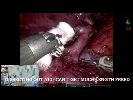 Cirugía robótica para el secuestro intralobar (segmentectomía S6+10 izquierda)