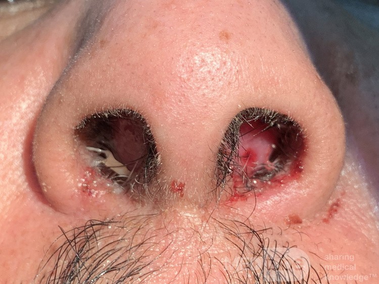 Hematoma septal postraumático