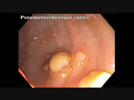 Colonoscopia - colitis pseudomembranosa