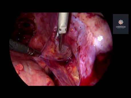 Cirugía de endometriosis profunda