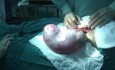 Un caso de tumores benignos de ovario asociados al embarazo