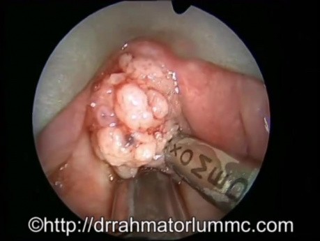 Uso del microdebridador para la eliminación de la papilomatosis laríngea
